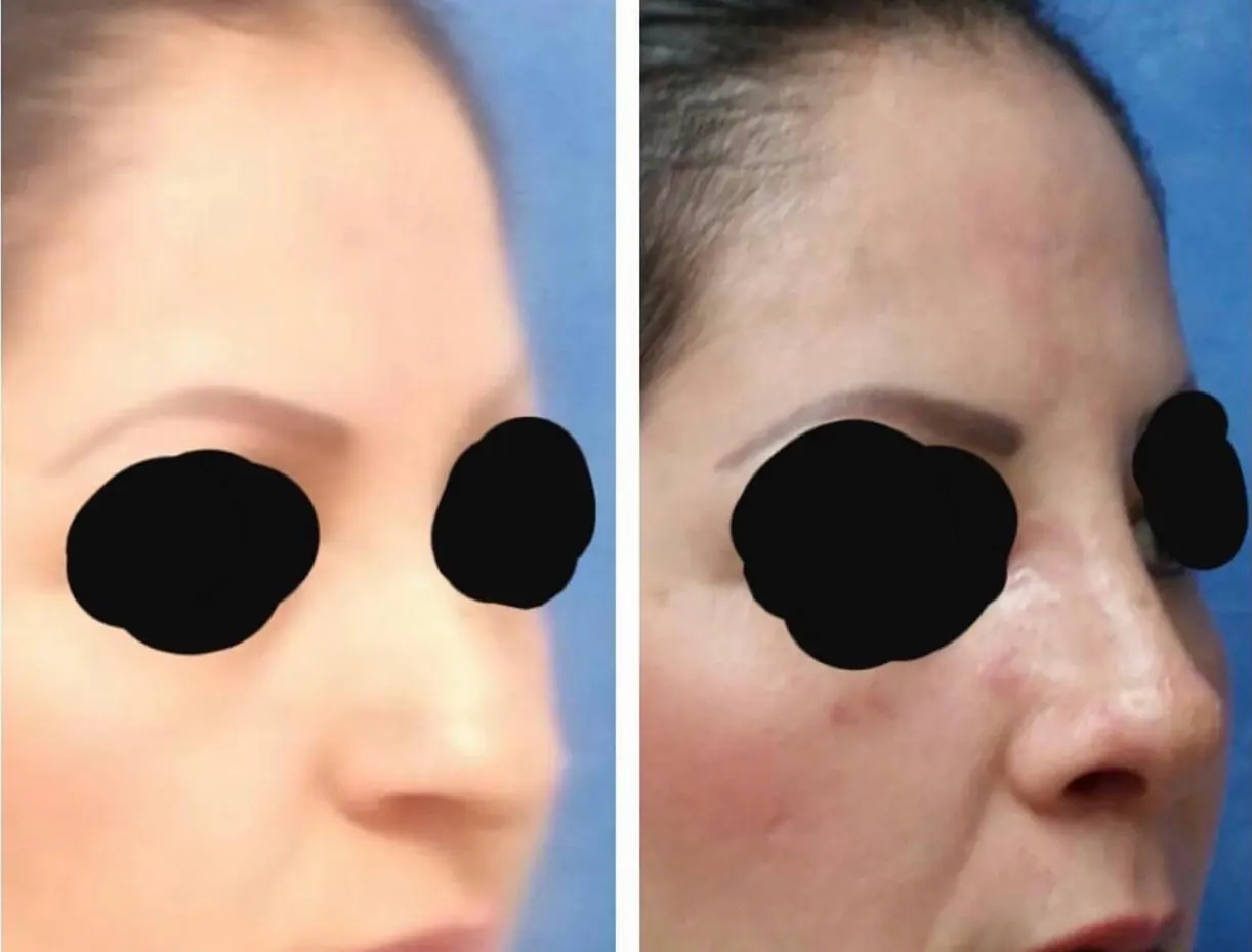 Procedimiento ORL 10 - Caso exitoso