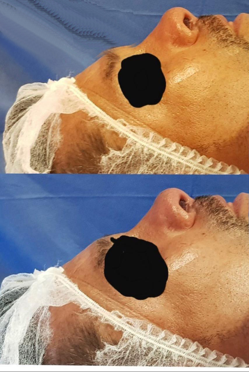 Procedimiento ORL 3 - Caso exitoso