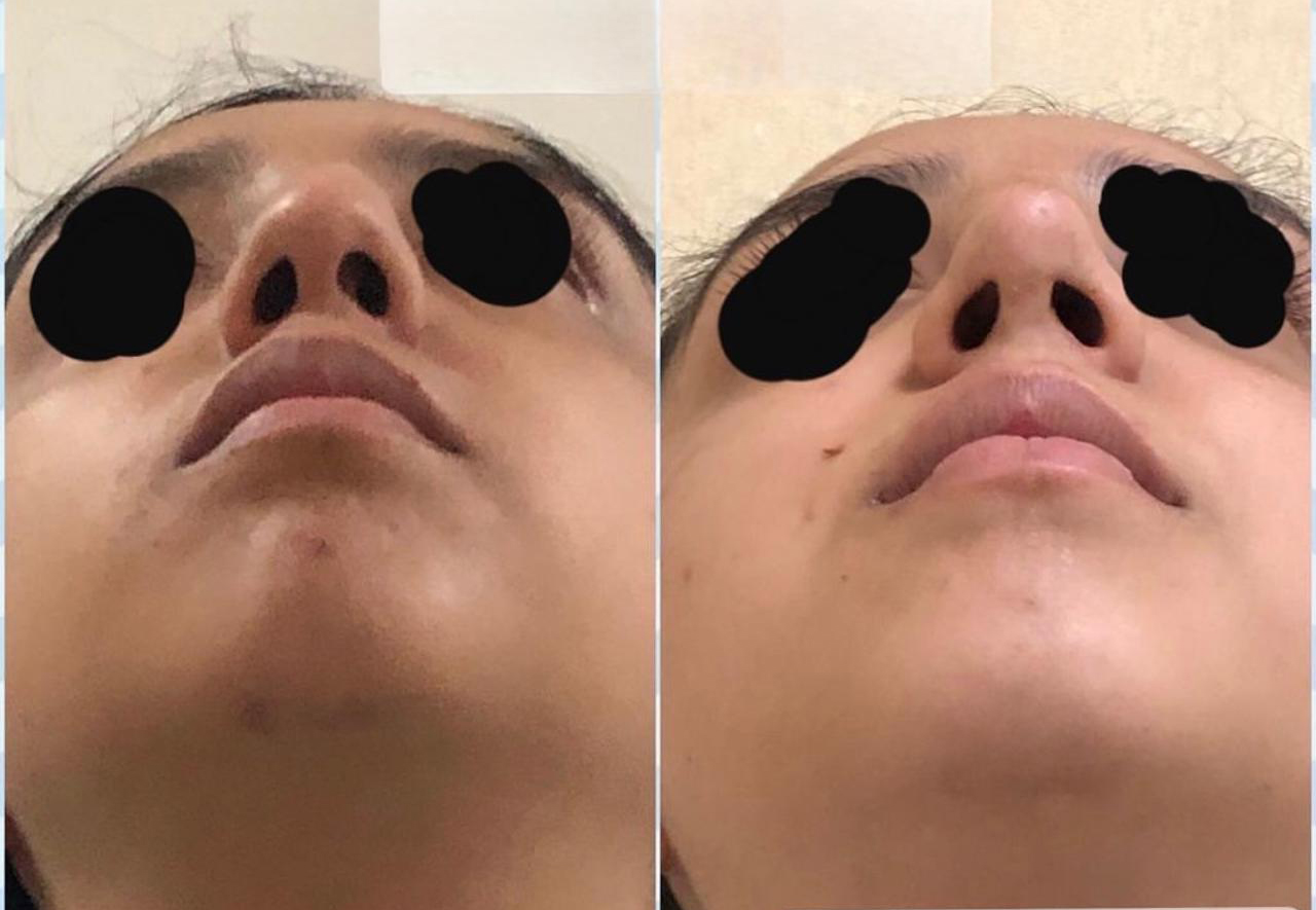 Procedimiento ORL 4 - Caso exitoso