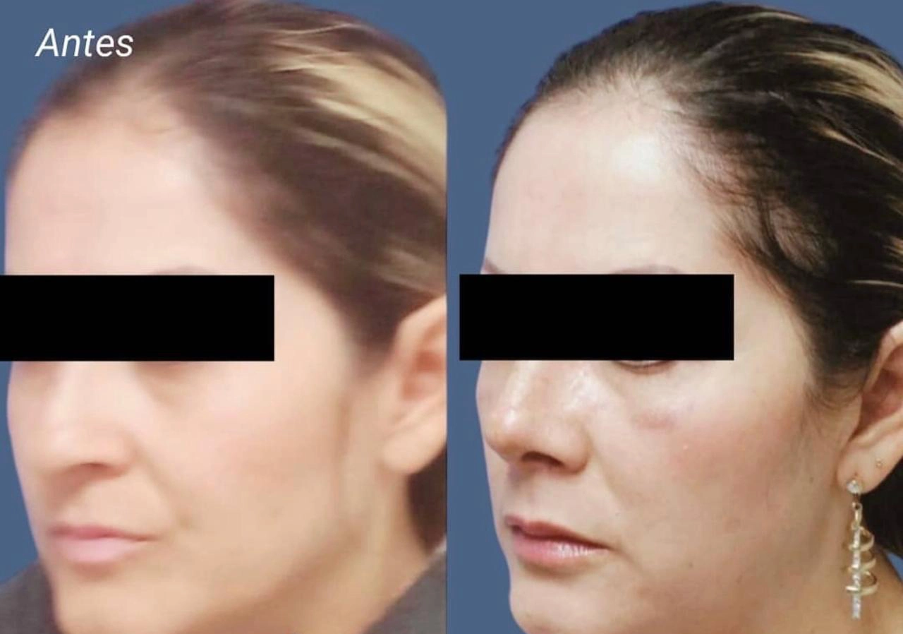 Procedimiento ORL 6 - Caso exitoso