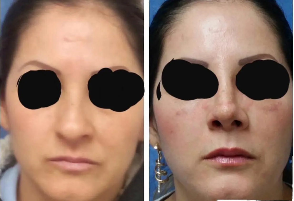 Procedimiento ORL 9 - Caso exitoso